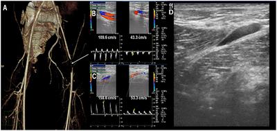 Simultaneous Onset of Pediatric Systemic Lupus Erythematosus in Twin Brothers: Case Report